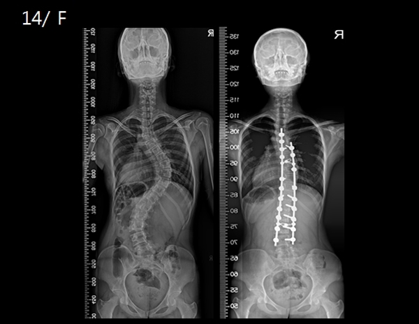 그림 14세 여자 척추측만증 환자. 흉추와 요추 만곡이 모두 주만곡인 환자로 수술 전(왼쪽) 64도, 54도인 각도가 변형교정술 및 후방 기구 고정술 후(오른쪽) 18도, 14도로 교정됐다.