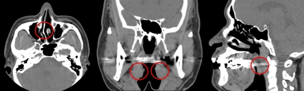 코골이 환자들의 CT영상 - (왼쪽부터) 비중격 만곡증, 편도 비대, 늘어진 목젖 소견