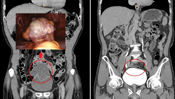 희귀 거대 요관막암 제거 전 CT 사진(좌측)과 3D 영상 사진(좌측 상단), 제거 후 CT 사진(우측) 비교