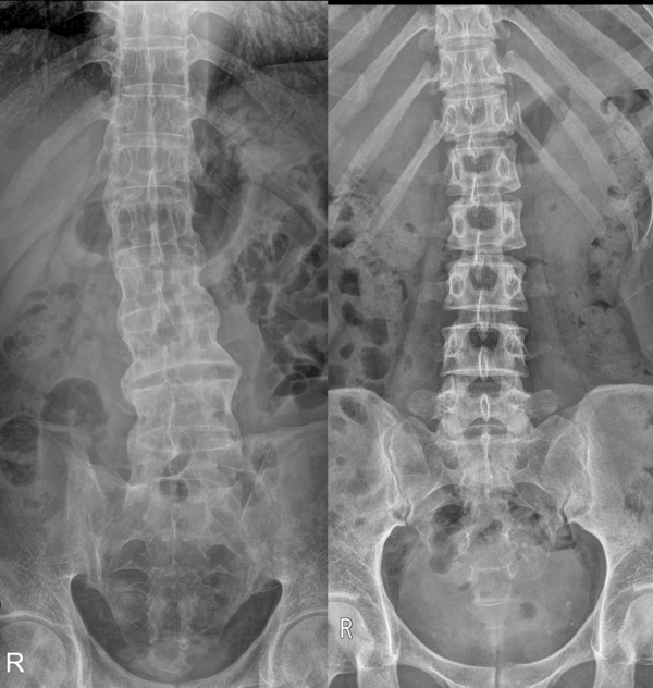 강직성 척추염(왼쪽)은 정상 척추(오른쪽)보다 관절 없이 하나의 긴 뼈처럼 이어진 모습을 빗대 ‘대나무 척추(bamboo spine)’라고 부른다