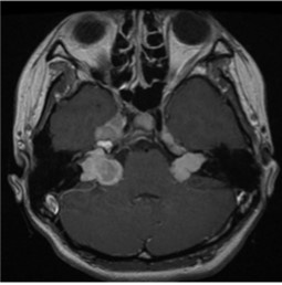 양측 청신경종양을 가진 2형 신경섬유종의 대표 뇌 MRI(자기공명영상)